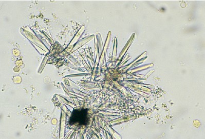 uric acid in urine crystals